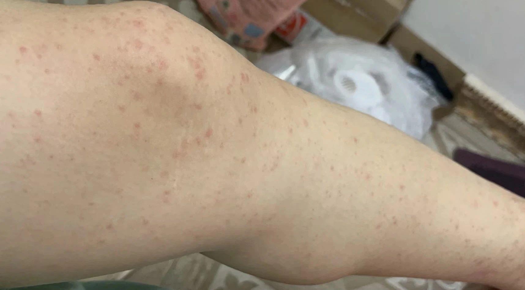 警惕基孔肯雅热！广东佛山已超千例感染