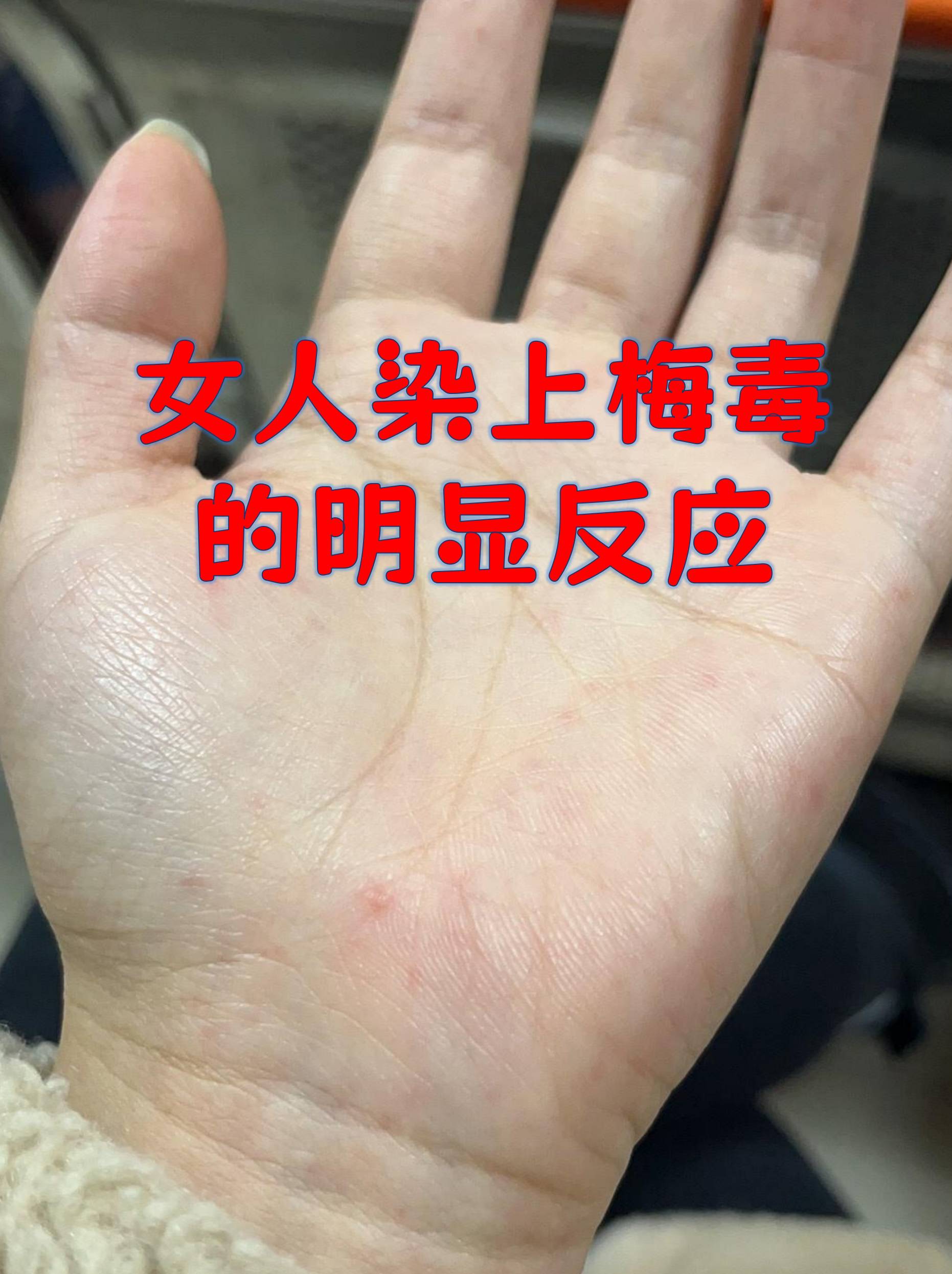 研究人员发现迄今最早梅毒螺旋体感染记录